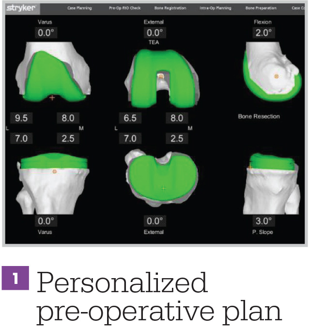 Personalized Pre-Operative Plan